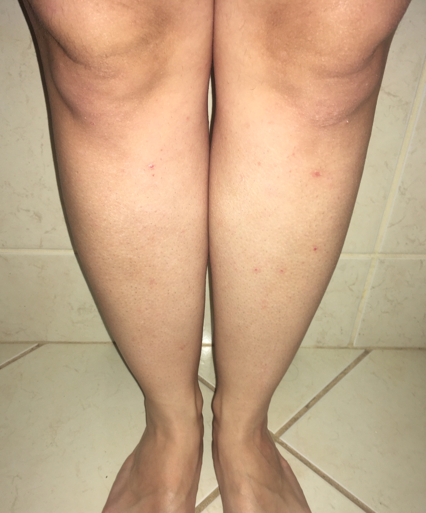 Perna após tratamento com Tend Skin — foliculite eliminada e pele lisa
